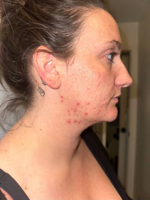 How Gut Health Could Be the Missing Piece in Your Acne Journey