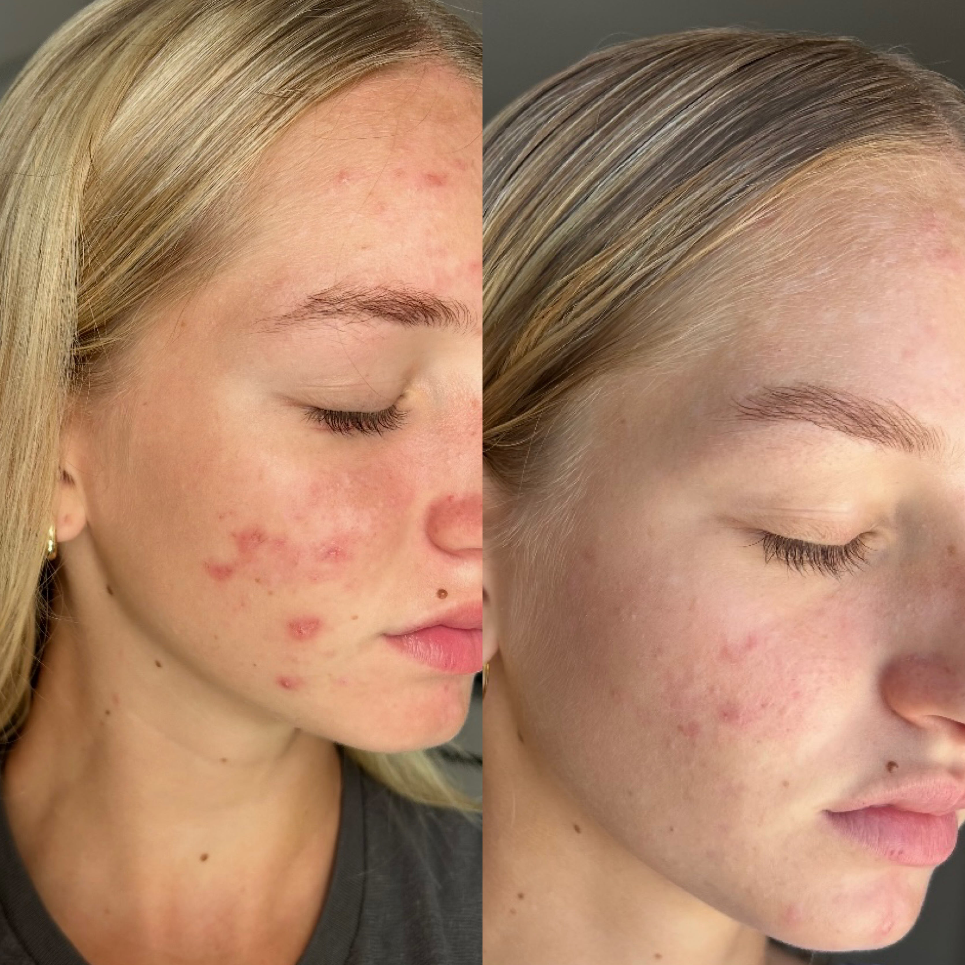 How to Treat Acne: Your Complete Guide to Clearer Skin