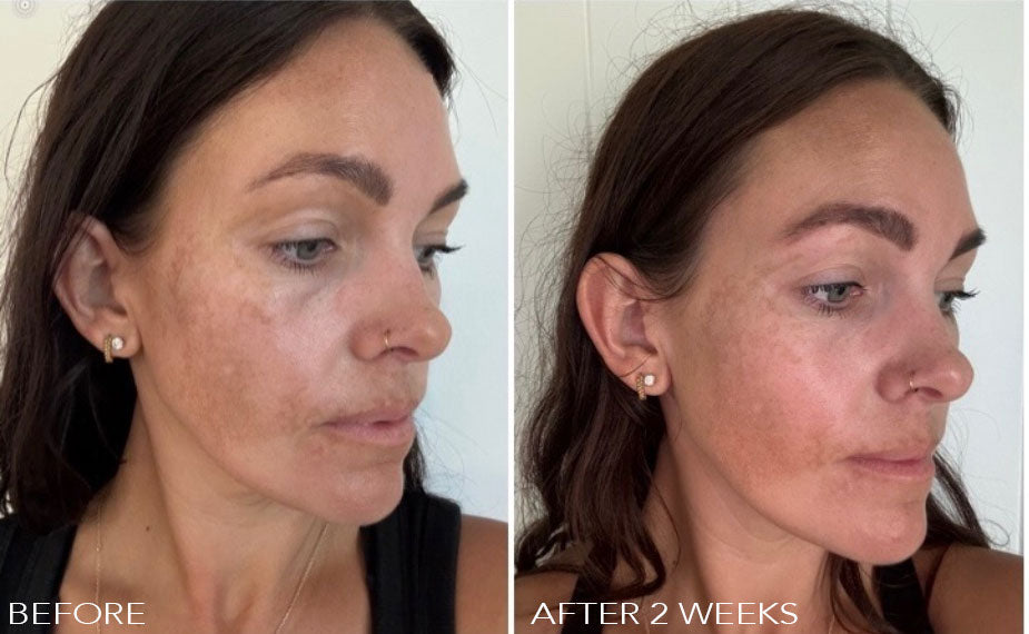 Understanding Melasma: Embrace Your Skin’s Journey with Sunshe