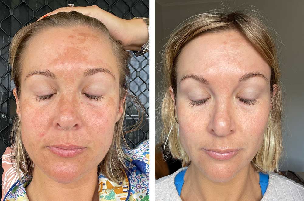 How to Build a Pigmentation Skincare Routine