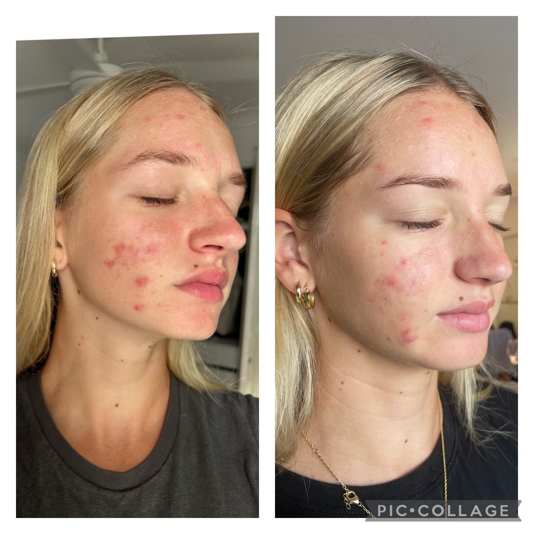 ClearComplex Acne Serum with Azelaic Acid & Salicylic Acid