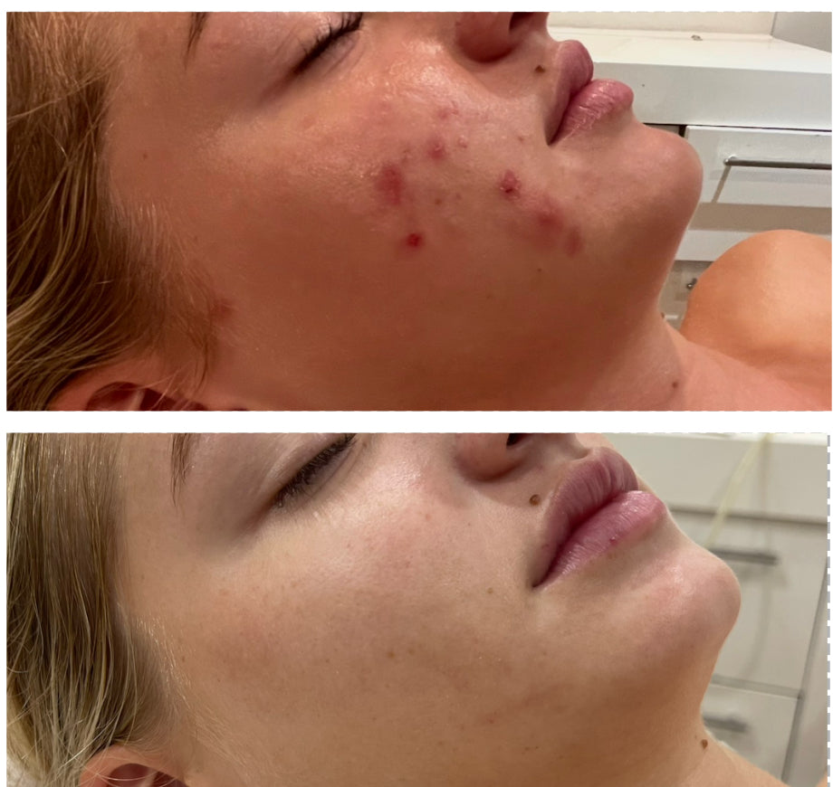 ClearComplex Acne Serum with Azelaic Acid & Salicylic Acid