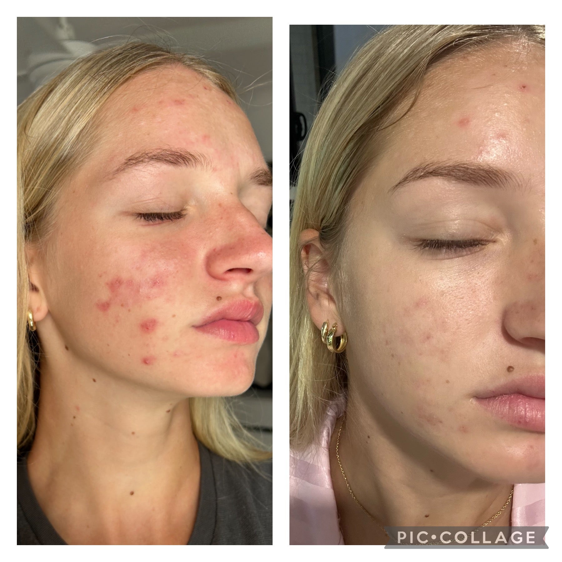 ClearComplex Acne Serum with Azelaic Acid & Salicylic Acid